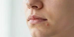herpes du visage